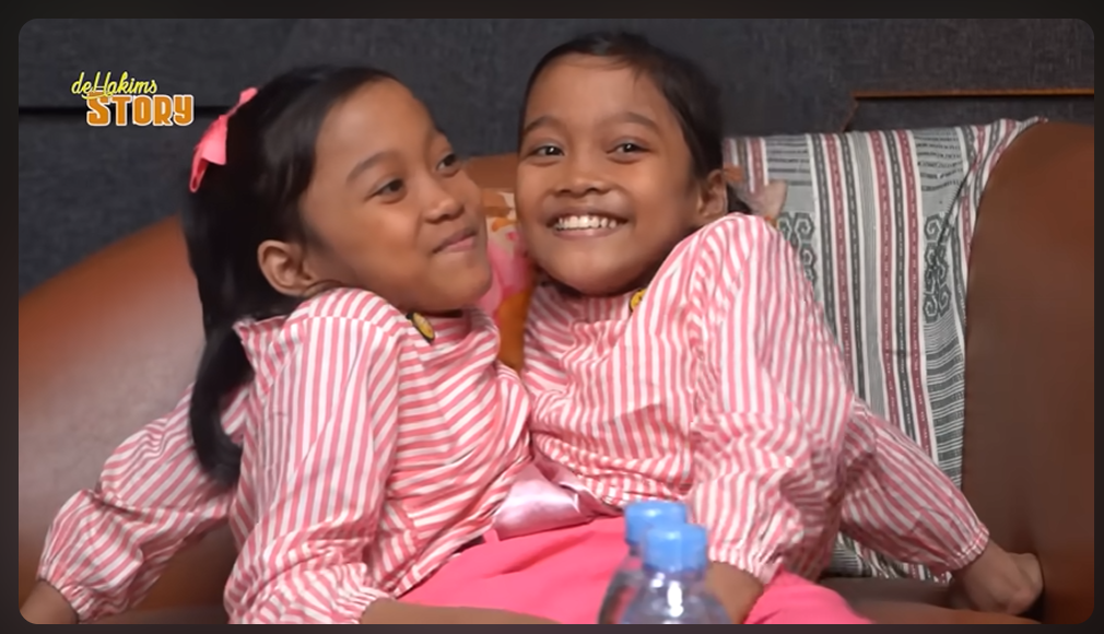 Dewi dan Putri, kembar siam asal Garut.